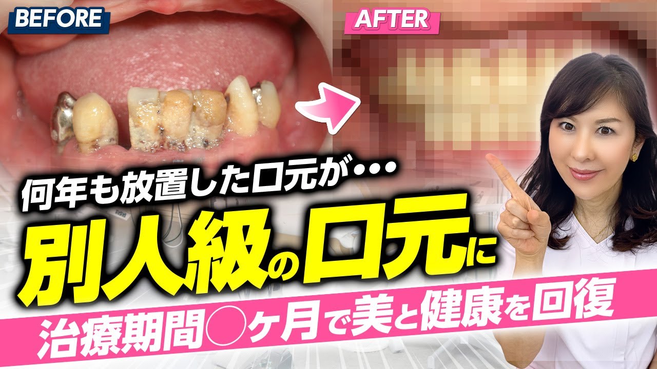 【症例紹介】歯医者にも行けずに放置した状態をセラミックできれいにしました！【アイエスデンタルクリニック】