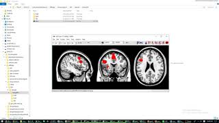 ROI figure generation using MRIcron and Marsbar