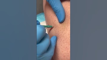Derm performs skin cancer testing! #skincancer #mole #dermreacts