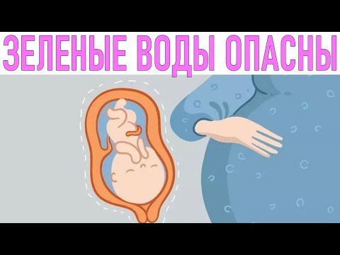 РЕБЕНОК РОДИЛСЯ С ЗЕЛЕНЫМИ ВОДАМИ | Синдром аспирации мекония у новорожденных