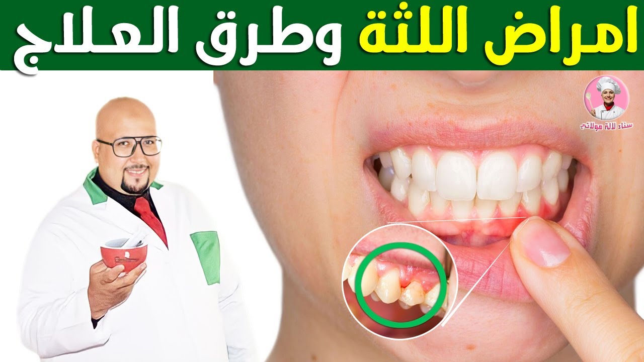 أمراض اللثة الأسباب وطرق العلاج مع الدكتور عماد ميزاب و الدكتورة فاطمة الزهراء كنيس مجدوب