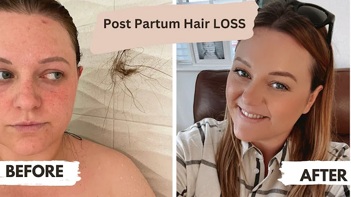 POST PARTUM HAIR LOSS | 6 tips | Healthy regrowth ...