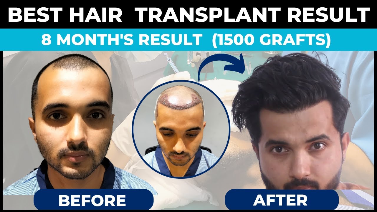 Best Hair Transplant Result Saurabh Kukreti || Frontal Hairline Hair  Transplant || Hairmate Clinic - YouTube