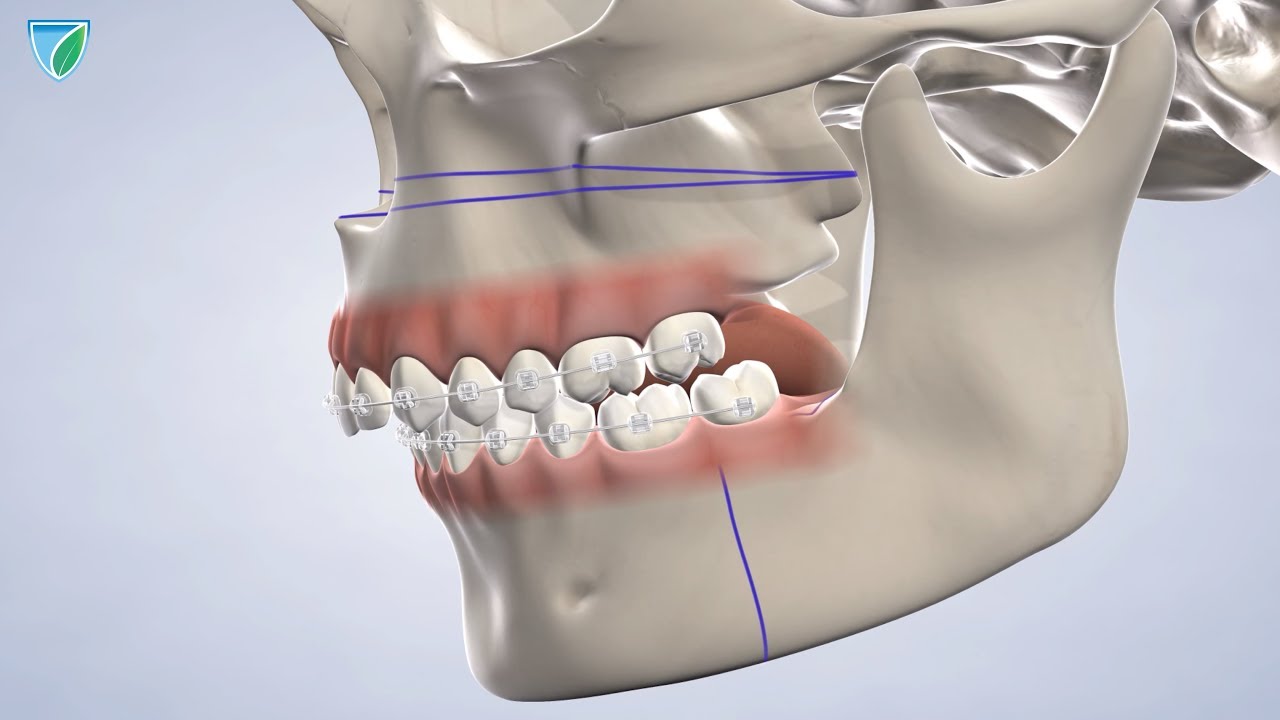 Jaw Surgery at Upstate Oral Surgery & Dental Implants, Watertown, NY