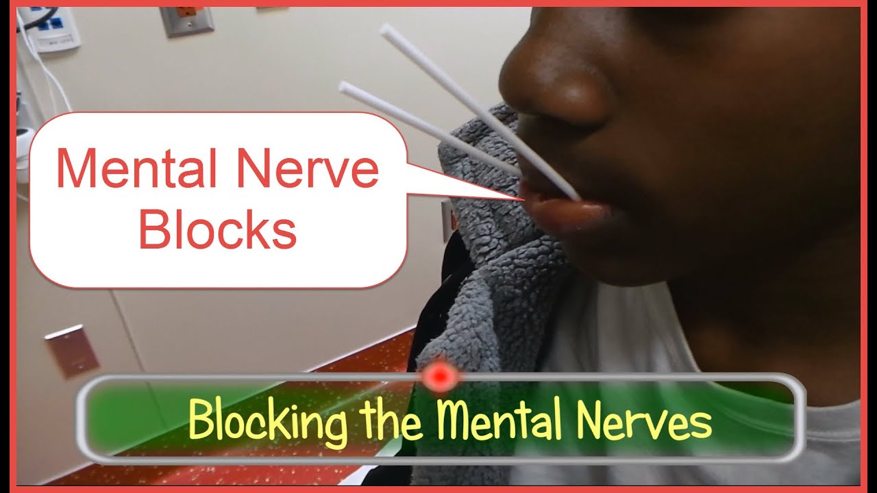 Blocking the Mental Nerves YouTube