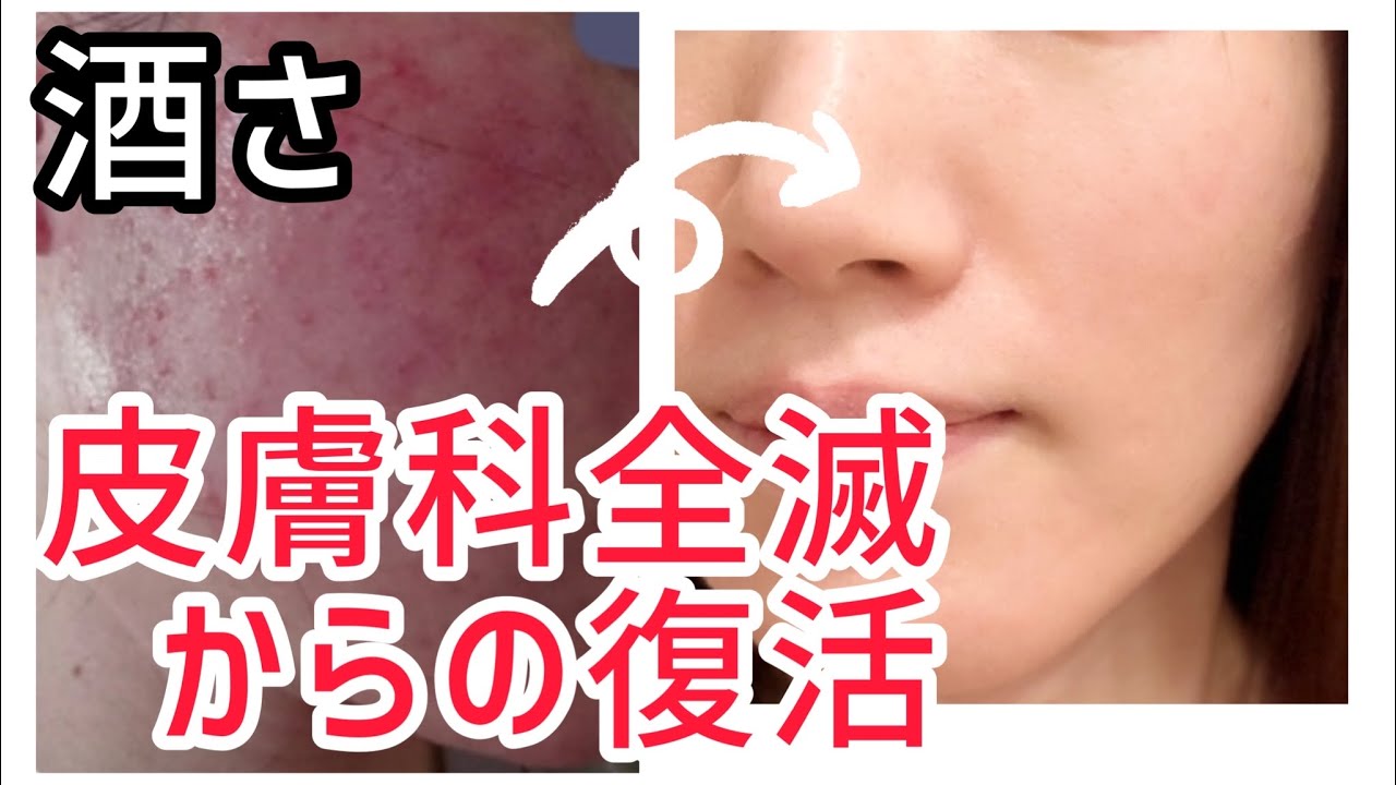 【酒さ】医療では改善できないけど、最短３ヶ月で改善できる方法はありますvol.451