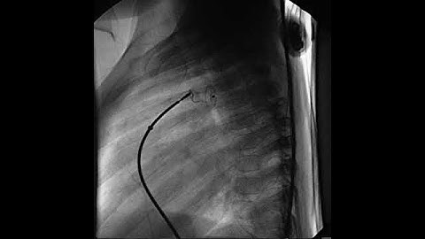 PDA   occluder prior to release