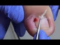 Super deep ingrown armor! The nails are attached to the skin and bleed【辥一刀】