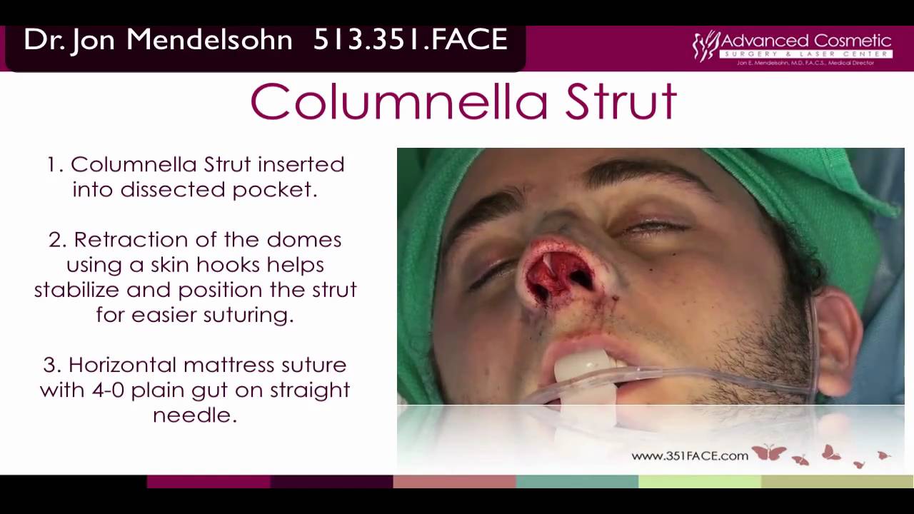 Rhinoplasty Placing A Columnella Strut For Support Youtube Rhinoplasty Placing A Columnella Strut For Support Youtube