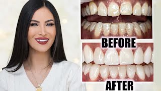 COMPOSITE VENEERS - Are They Worth It? My Smile Transformation