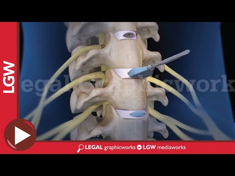 Cervical Discectomy & Fusion Surgery 3D animation C3 C4 C5 C6