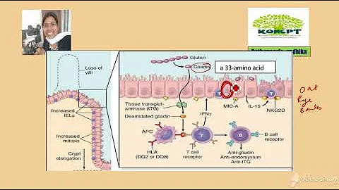 #KONCPT#Pathopea...  5 min discussion; Celiac disease