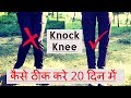 Knock Knee Kaise Thik Kare 20 Din Me Exercises | Knock Knee Problem Solution In Hindi