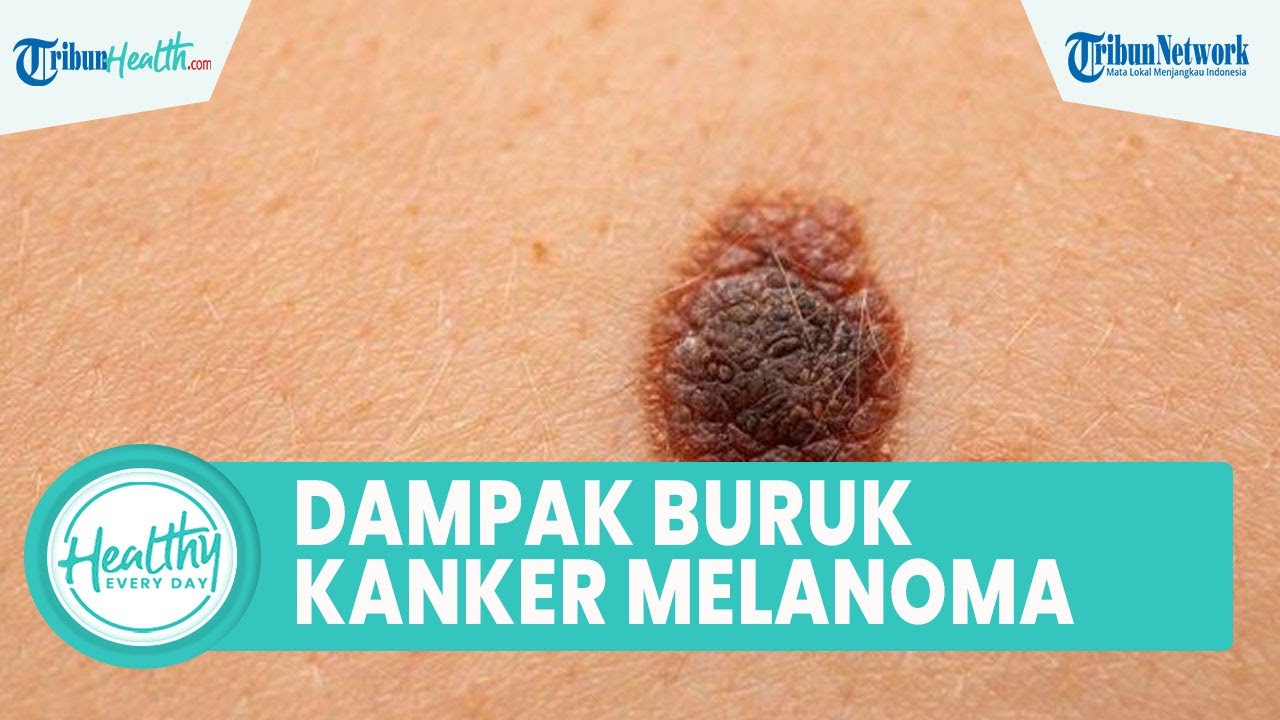 Dampak Buruk Kanker Melanoma, Bisa Picu Komplikasi bahkan Satu di Antaranya Kanker Getah Bening