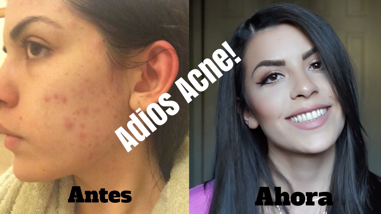 que pastilla anticonceptiva es buena para el acne