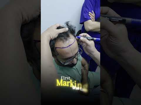 Hair Transplant Training for Doctors in Surat | Hair Transplant Surgeon Training