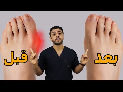 ألم صباع القدم الكبير اهم التمارين لعلاج الم وتورم وخشونة والتهاب صباع القدم الكبير ابهام القدم