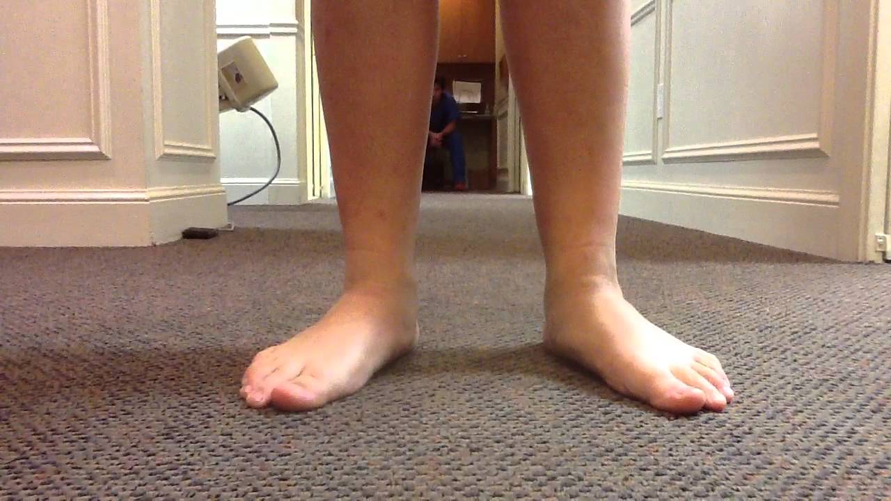 Gait analysis of pediatric flatfoot prior to surgical correction SFISM