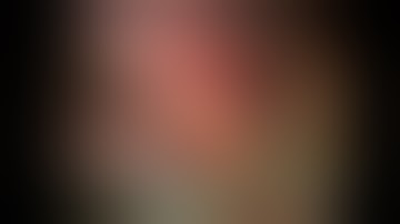 VATS Resection of Pulmonary Sequestration