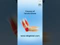 Causes of Tennis Elbow