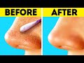 HOW TO GET RID OF BLACKHEADS || Clear Skin Tips And Tricks