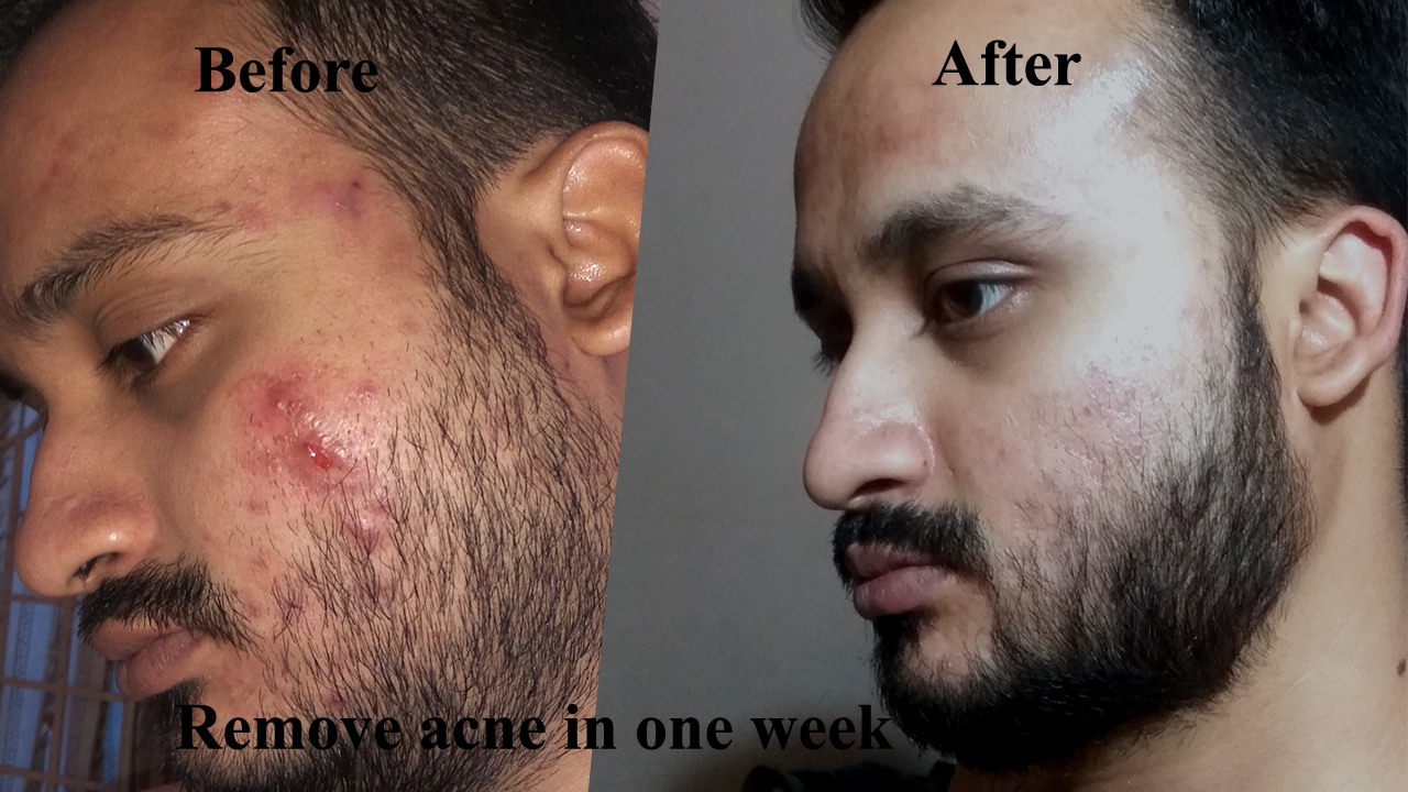 how to remove acne within 7 to 8 days {hindi} acne ko kese dur karey