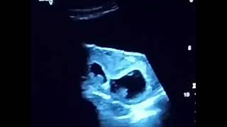 Twin pregnancy #ultrasound #imaging #technology #2026 #shorts#pregnant #obstetrics #twins #radiology