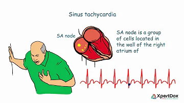 Quais são os sintomas da taquicardia sinusal?