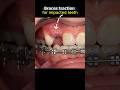 Exposure hidden teeth and pull out using braces #orthodontist #orthodontics #braces #dentist #teeth