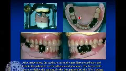 DENT 718: Partial denture attachments