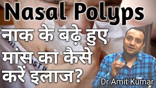 Nasal Polyps | नाक के बढ़े हुए मांस का कैसे करें इलाज कैसे जड़ से ठीक करें Treatment Of Nasal Polyps