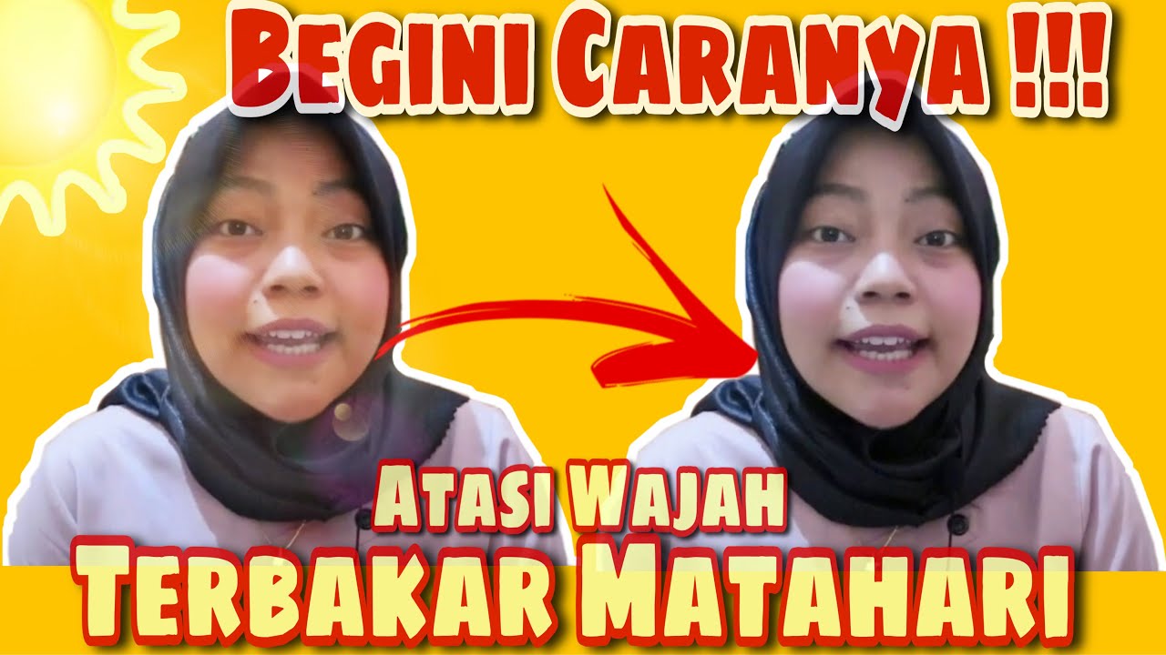 Cara Mengatasi Wajah Terbakar Matahari