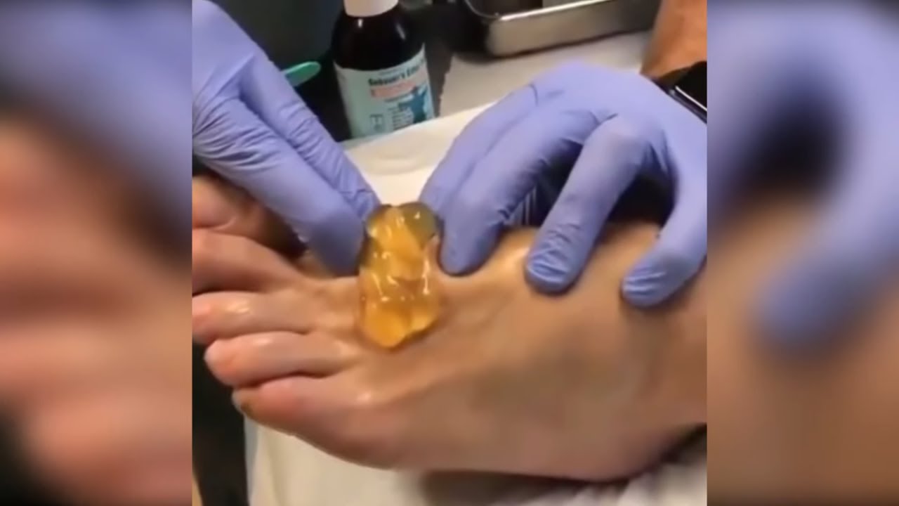 Popping huge blackheads and Pimple Popping - Best Pimple Popping Videos #16