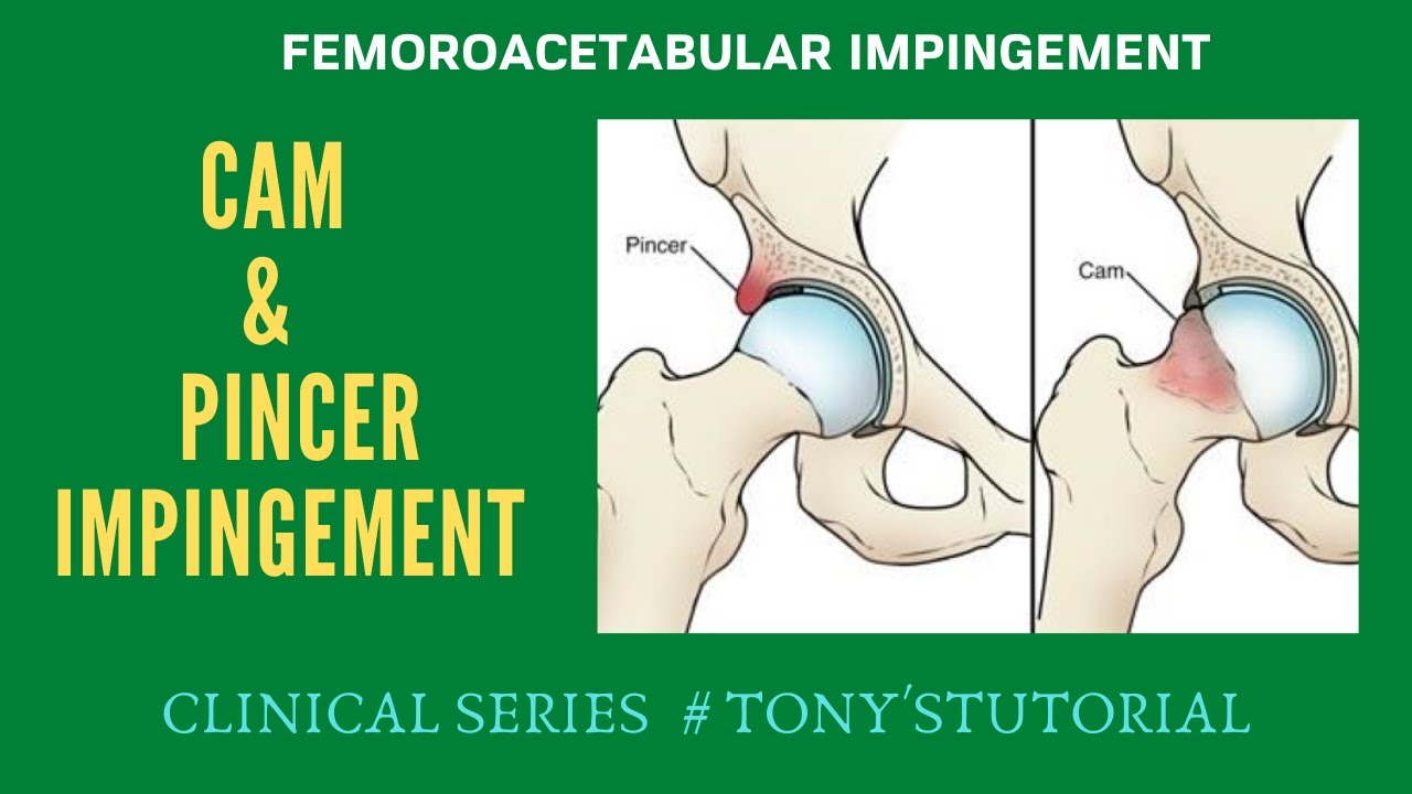 FEMEROACETABULAR IMPINGEMENT# & Pincer Impingement YouTube