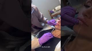 Preenchimento Labial - ajustando assimetria! Paciente já com lábio de outro profissional!
