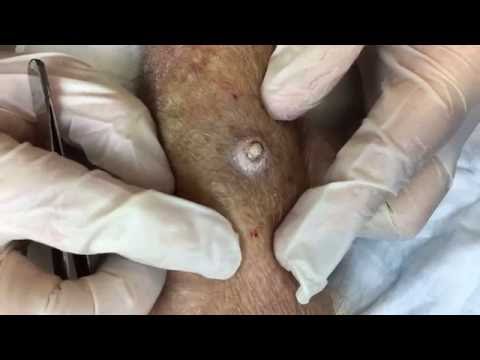 Surgical Excision of Keratoacanthoma