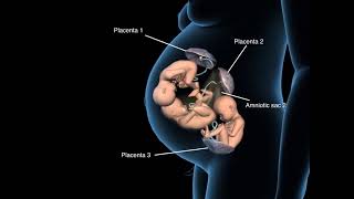 Types of triplets pregnancy - Trichorionic triplets - 3D Anatomical Visualization