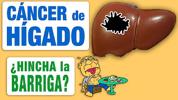 ¿Puede el hígado hincharte el estómago?