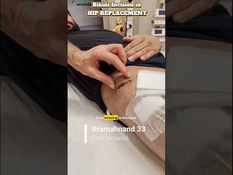 Bikini Incision Hip Replacement with MIS Technique