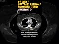 CT Chest Anatomy at Pulmonary Trunk level and contrast pathway | #anatomy #radiology #medical