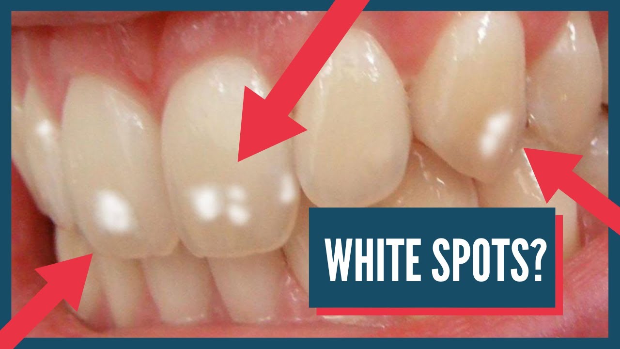 What Causes White Spots On Teeth And How To Get Rid Of Them Youtube