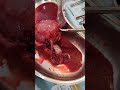 Hysterectomy +FallopainTube +ovary Removal from The body #mbbs