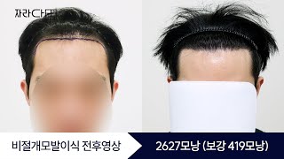 2627모낭(보강419모낭) 대량이식 정수리 전두부 헤어라인 #자라다의원