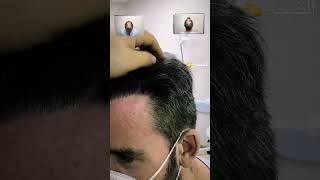 نتيجة بعد الزراعة #fypシ #زراعة_الشعر #الخليج