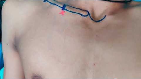RAA Online - Ultrasound guided infraclavicular axillary vein (Subclavian vein )cannulation