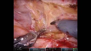 Robotic pyeloplasty on the right side   Part02