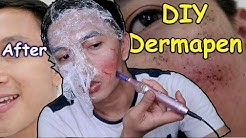 BOPENG & BEKAS JERAWAT HILANG SEKETIKA Dengan Cara ini || DIY Tutorial Dermapen - Durasi: 15.45. 