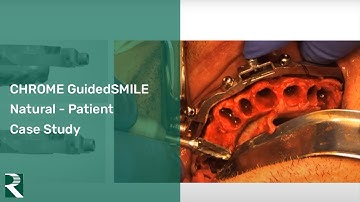 CHROME GuidedSMILE Natural - Full Arch Patient Case Study