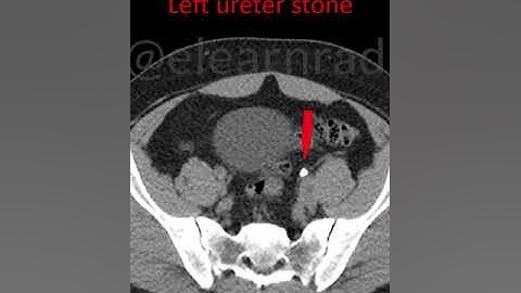 Ureter stones