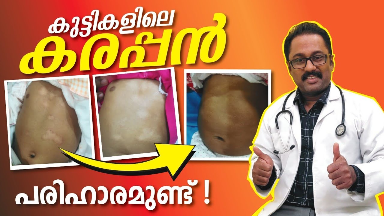 കുട്ടികളിലെ കരപ്പൻ മാറാൻ Karappan treatment malayalam #atopicdermatitis ...